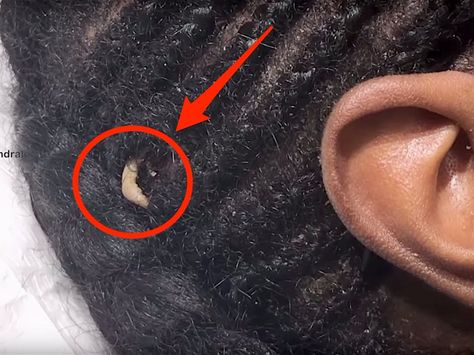 Dr. Pimple Popper found a bizarre growth like a fingernail on a patient's head Pimple Inside Nose, Head Pimples, Huge Pimple, Ear Pimple, Pimple Popper Tool, Honey Face Cleanser, Blind Pimple, Diy Facial Mask, Pimples Under The Skin