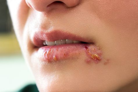 A dedicated and meticulous dental hygienist, you may find yourself noticing small details that are unnoticed or dismissed by most people. So when a patient presents for her prophy with an active herpes simplex lesion on her lip (herpes labialis), your antennae immediately go up. As you mentally determine the best course of action to take, … Fever Blister Causes, Cold Sore Scab, Blister In Mouth, Fever Blister Remedy, Bacillus Anthracis, Home Remedies For Fever, Fever Blister, Canker Sore, Cold Sore