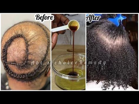 Only two ingredient and my hair won't stop growing after years of damaged hair !! I'm still shock -… | Damaged hair, Hair growth serum diy, Natural hair growth tips Alopecia Hair Growth, Hair Growth Serum Diy, Hair Regrowth Women, Natural Hair Growth Tips, Two Ingredient, Hair Regrowth Treatments, Hair Remedies For Growth, Regrow Hair, Hair Growing