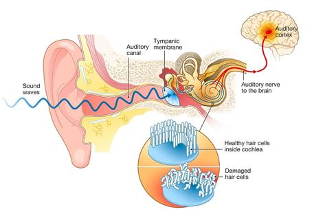 Scientists developed a brilliant in-ear device that can correct hearing loss without requiring batteries People With Hiv, Reactive Oxygen Species, Cochlear Implant, Hearing Loss, Brain Waves, Hearing Aids, Sound Waves, Damaged Hair, Biology