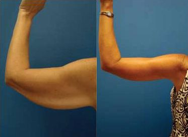 Arm Liposuction at HarleyBodyClinic in London Body Plastic Surgery, Vaser Lipo, Lipo Before And After, Body Contouring Surgery, Smart Lipo, Los Angeles Hollywood, Arm Exercises, Reconstructive Surgery, Cool Sculpting