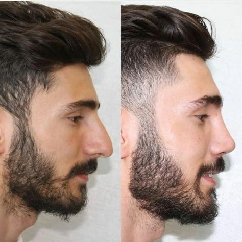 Mens Nose Job, Male Nose Job Before And After, Men Nose Job, Men Rhinoplasty, Male Nose Job, Male Rhinoplasty, Male Nose, Liquid Rhinoplasty, Greek Nose