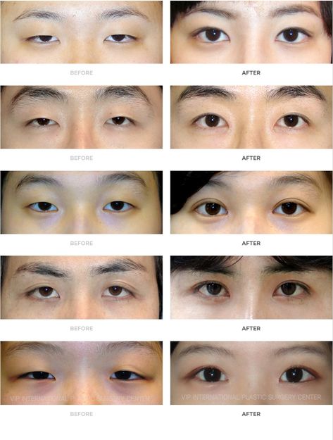 Eye Lid Types, Korean Eye Surgery, South Korean Plastic Surgery, Plastic Surgery Korea, Plastic Surgery Fail, Facial Expressions Drawing, Plastic Surgery Photos, Korean Eye, Celebrity Plastic Surgery