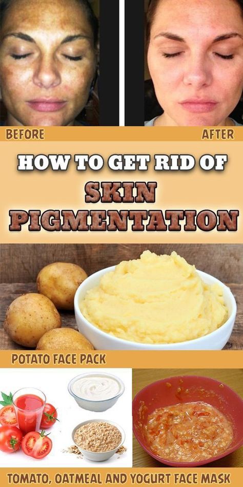 Spots On Forehead, Yogurt Face Mask, Potato Face, Brown Age Spots, Brown Spots On Skin, Spots On Legs, Treating Hyperpigmentation, Skin Pigmentation, Brown Spots Removal