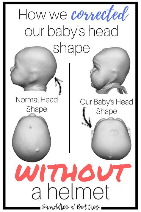 How we corrected our baby's flat head without a baby helmet. It was suggested that our daughter be put in a Doc Band at 4.5 months of age. We did a variation of alternative exercises and increased tummy time activities which drastically helped change the shape of her head to the point where the Doctor advised us a helmet was no longer necessary! Baby Head Shape, Flat Head Baby, 5 Month Old Baby, 4 Month Old Baby, Baby Helmet, Tummy Time Activities, 4 Month Olds, Baby Advice, Baby Supplies