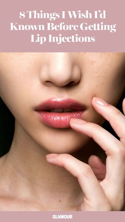 Lip Filler Tips, Lip Filler Injection Points, Perfect Lips Injections, Lip Injections Before And After 1ml, 1 Syringe Lip Filler, Lip Injections Before And After, Bad Lip Injections, Lip Injections Juvederm, Cold Sore Lip