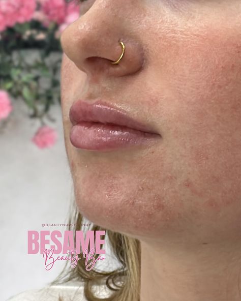 Swipe to see her before! 💕 💉1ml syringe over 2 sessions 💉Minor bruising & swelling expected 💉Allow 2 weeks for lips to fully heal 💉Book your lip filler appointment with me 💕 #besamebeautybar #besamebeautymedspa #dallasnurseinjector #lipfillerbeforeandafter #dallaslips #dallaslipfiller #forneynurseinjector #forneysmallbusiness #latinaownedbusiness #confidenceboost #beautyboost #youbutbetter #yourlipsbutbetter #lipfiller #botoxfiller #halfsyringe #halfsyringelipfiller #fullsyringe #fullsyring... Full Syringe Lip Filler Before And After, 1 Syringe Lip Filler, Lip Filler Memes Funny, Lip Injections Before And After 0.5ml, .5 Syringe Lip Filler, Beauty Boost, Botox Fillers, Lip Fillers, Med Spa