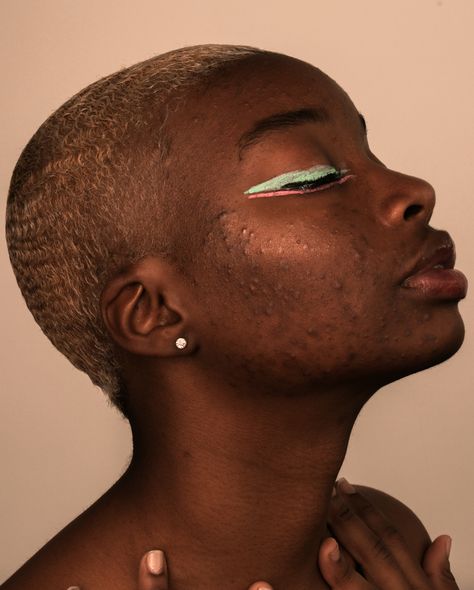 model: @nazhayabarcelona Strech Marks Model, Acne Positivity Art, Girl With Acne Aesthetic, Acne Black Women, Models With Acne, No Makeup Photoshoot, Pretty People With Acne, Girls With Acne, Acne Model