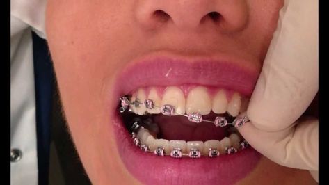 Teeth After Braces, After Braces, Ceramic Braces, Getting Braces, Braces Off, Manifesting Vision Board, Diy Chicken Coop, Diy Backdrop, Braces