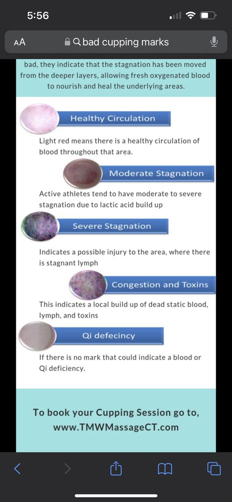 Cupping Therapy Placement Chart, Cupping Therapy Color Chart, Cupping Therapy Chart Trigger Points, Cupping Placement Chart, Cupping Therapy Chart, Suction Cup Therapy, Needling Therapy, Cupping Points, Clay Therapy