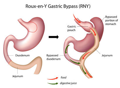 Roux en Y Gastric Bypass Gastric Band, Bariatric Surgeon, Sleeve Gastrectomy, Sleeve Surgery, Laparoscopic Surgery, Bypass Surgery, Gastric Bypass, Plastic Surgery, Surgery