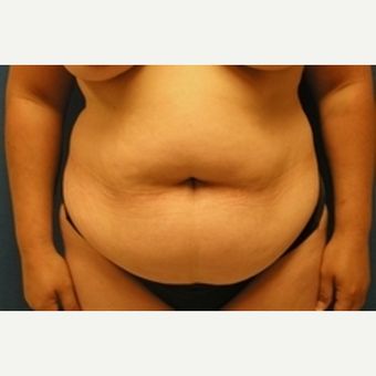 Lipo360 Before And After, Sonobello Before And After Stomach, Plus Size Tummy Tucks Before And After, Tummy Tucks Before And After, Tummy Tucks Recovery, Lipo Before And After, Medical Consultation, After Pictures, Tummy Tucks