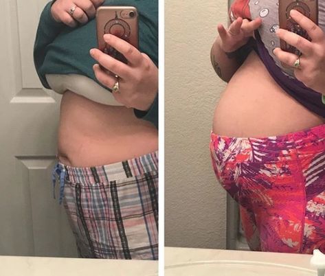 Women share photos of their bloated bellies to show painful reality of living with endometriosis Female Health Problems, Endo Belly, Average Woman, Bloated Belly, Intimate Photos, Leg Pain, Abdominal Pain, Hot Flashes, Health Problems