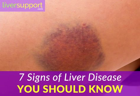 Symptoms of Liver Disease You Should Know Liver Cleanse Juice, Enlarged Liver, Natural Liver Detox, Liver Care, Liver Issues, Kidney Detox, Detox Your Liver, Liver Failure, Liver Detox