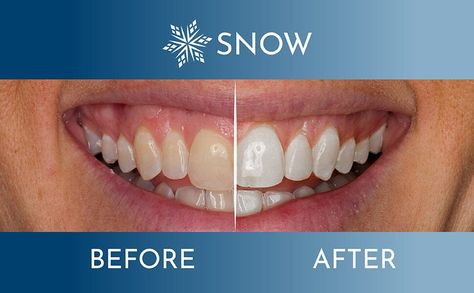 SNOW® Teeth Whitening Kits, Toothpaste, Strips & Electric Toothbrush Teeth Whitening Mouthwash, At Home Teeth Whitening, Snow Teeth Whitening, Home Teeth Whitening, Get Whiter Teeth, Teeth Whitener, Whiter Teeth, Grills Teeth, Teeth Whitening Strips