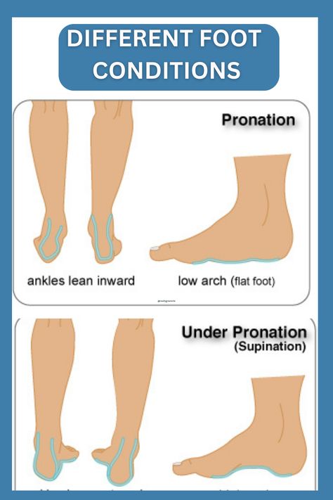 Foot pronation is a natural and essential movement that occurs when you walk or run. It refers to the inward rolling motion of your foot as it makes contact with the ground. This movement helps absorb shock, distribute weight, and adapt to different surfaces, ensuring optimal stability and comfort. Understanding your unique pronation pattern is crucial for selecting the right footwear and preventing potential discomfort or injury. 👟🚶‍♀️🏃‍♂️ #FootPronation #HealthyStride #FootCareTips Sesamoid Bone, Foot Injury, Walking Shoes Women, Foot Pain, Walk On, Walking