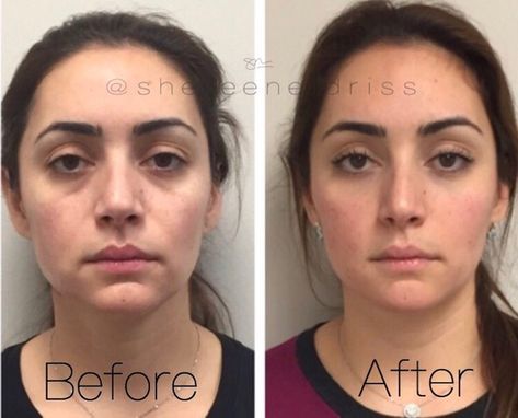 Cosmetic Injections, Botox Facial, Derma Fillers, Cosmetic Fillers, Under Eye Fillers, Face Fillers, Cheek Fillers, Facial Fillers, Cosmetic Injectables