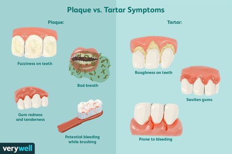 How To Remove Plaque From Teeth, How To Clean Retainers, Stages Of Tooth Decay, Rhs Dental Exam, Dental Sealants, Use Your Dental Benefits, Tartar Removal, Swollen Gum, Dental Plaque