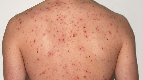 Internal shingles: What to know about shingles without a rash Shingles Symptoms, Cassava Leaves, Shingles Rash, May Spread, Itchy Rash, Internal Organs, Home Health Remedies, Nerve Pain, Signs And Symptoms