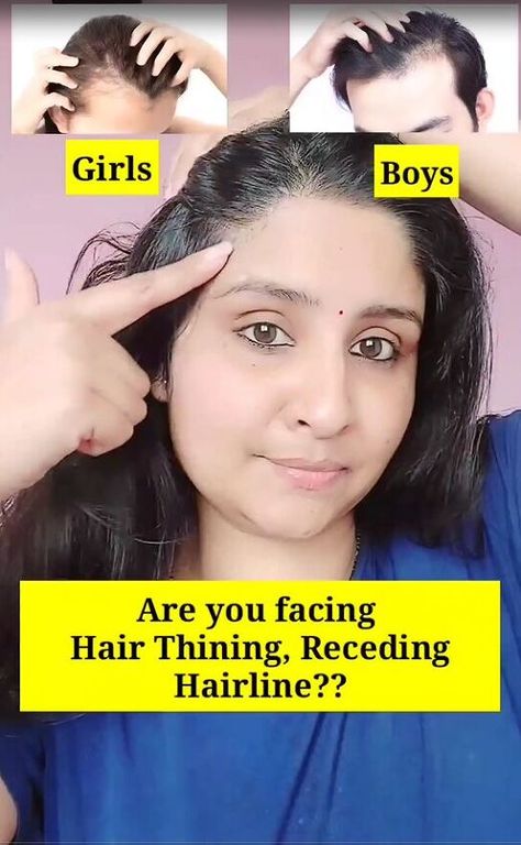 Do you have bald patches, thinning hair, or big forehead problems? For the recipe and application tips, follow along with this simple tutorial. How To Grow Hair From Bald, How To Grow Hair On Bald Patches, Forehead Hair Growth Tips, Forehead Hair Growth, Grow Baby Hair, Bald Hair Growth, Hair Growth Mask Diy, Diy Hair Growth Oil, Receding Hair