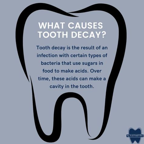 Tooth decay is damage to a tooth's surface, or enamel. It happens when bacteria in your mouth make acids that attack the enamel. Tooth decay can lead to cavities (dental caries), which are holes in your teeth. If tooth decay is not treated, it can cause pain, infection, and even tooth loss. Dental Awareness, Dental Post, Severe Tooth Pain, Dental Assistant Study, Dental Quotes, Dental Advertising, Dental Studio, Dental Cabinet, Dental Social Media