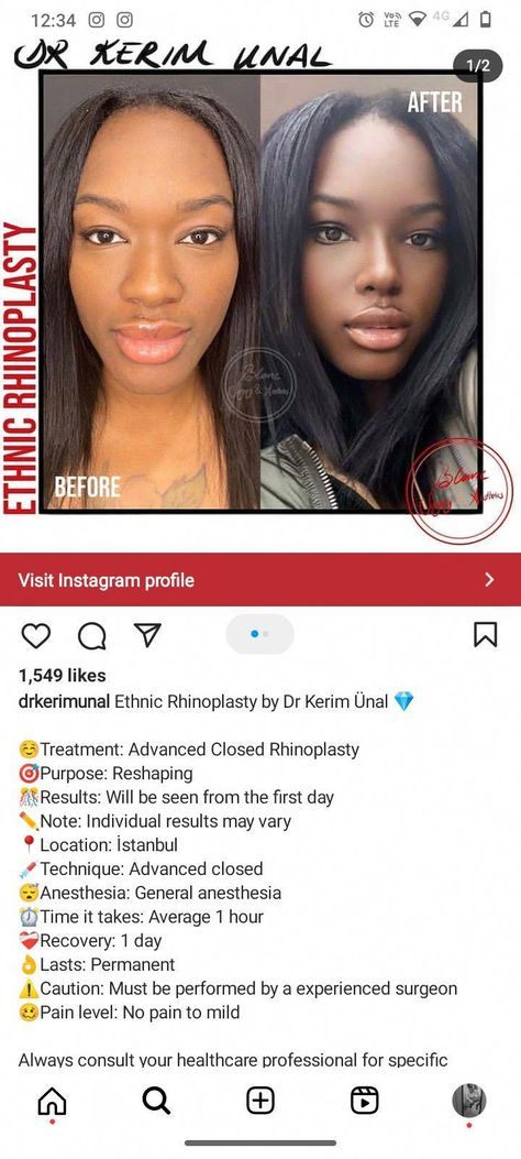 Rhinoplasty Before After Wide Nose Jobs, Black Rhinoplasty Before And After, African American Rhinoplasty, Rhinoplasty Black Women, Black Nose Job, Ethnic Rhinoplasty African Americans, Nose Job Black Women, Wide Nose Women, Wide Nose Rhinoplasty