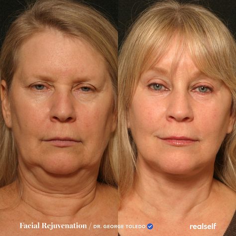 Excess droopy skin along the jawline and below the cheeks is commonly referred to as jowls. These nonsurgical and surgical procedures can help tighten the skin. How To Lift Sagging Jowls, How To Help Sagging Jowls, Sagging Facial Skin, How To Tighten Saggy Jowls, How To Tighten Jawline, Tighten Saggy Jowls, Neck Lift Naturally, Saggy Jowls Anti Aging, How To Reduce Sagging Jowls