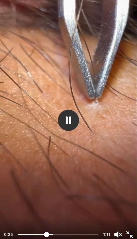 How To Get Rid Of Ingrown Hairs, Ingrown Hair Removal Videos, Remove Ingrown Hair, Get Rid Of Ingrown Hairs, Blackheads Removal Cream, Ingrown Hair Remedies, Shaving Bumps, Blackhead Remover Diy, Baking Soda For Hair