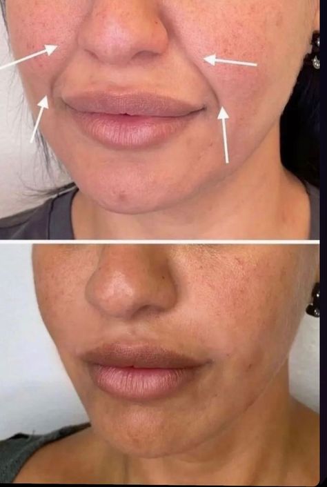 Lip Fillers Juvederm, Eye Lift Surgery, Facial Before And After, Face Injections, Botox Facial, Under Eye Fillers, Botox Before And After, Face Fillers, Botox Lips