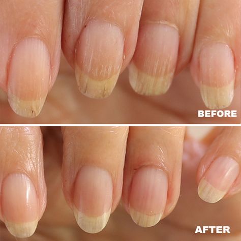 Getting Clean: The Journey of Gel and Acrylic Recovery | Bellasonic Beauty Gel French Manicure, Acrylic Tips, Weak Nails, Electric Nail File, Damaged Nails, Nail Bed, Nail Growth, Nail Files, Strong Nails