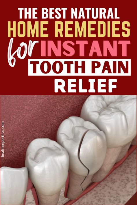 Here is a collage of teeth with a broken tooth Home Remedy For Tooth Ache Pain, Cavity Pain, Cavity Remedy, Wisdom Teeth Pain Relief, Tooth Pain Remedies, Wisdom Teeth Pain, Tooth Pain Relief, Teeth Remedies, Tooth Ache Relief