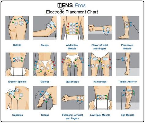 TENS unit electrode placement chart for different sports/life injuries. Repinned by SOS Inc. Resources pinterest.com/sostherapy/.: Tens Unit Placement Charts, Tens Placement, Tens Electrode Placement, Tens Unit Placement, Tens And Units, Tens Machine, Tens Unit, Ten Unit, Nerve Pain Relief