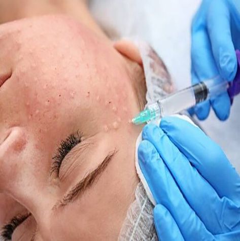 ● Delivery of Hyaluronic acid (HA) into the superficial and middle layer of the skin can be done in various ways, including micro-injections, microneedling pens, mesoguns and mesostamping. ● Bioreviatalization - involves micro-injections of Hyaluronic acid (HA) and nutrients into superficial and middle layer of skin. #vidaskinbeautycenter #skinbeautycenter #skincare #skincareroutine #agelessbyabovian #beauty #makeup #skin #lipocavitation #biorevitalization Aesthetic Dermatology, Skin Spots, Reconstructive Surgery, How To Look Handsome, Deep Wrinkles, Layers Of Skin, Health Magazine, Improve Skin Elasticity, Younger Looking Skin