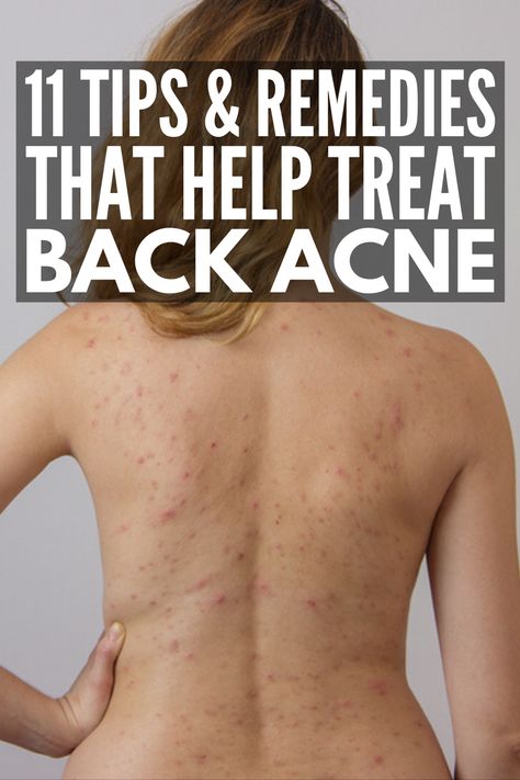 Back Acne Causes, Get Rid Of Back Acne, Rid Of Back Acne, Back Acne Remedies, Chest Acne, Back Acne, Scalp Problems, Bad Acne, Acne Overnight