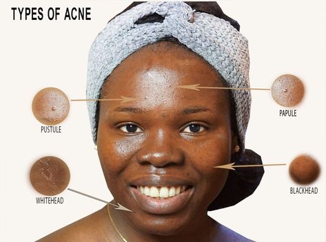 Face Acne Chart, Acne Types, Acne Placement Meaning, Acne Face Map, Papules Acne, Skin Routine Order, Acne Chart, Nodule Acne, Comedonal Acne