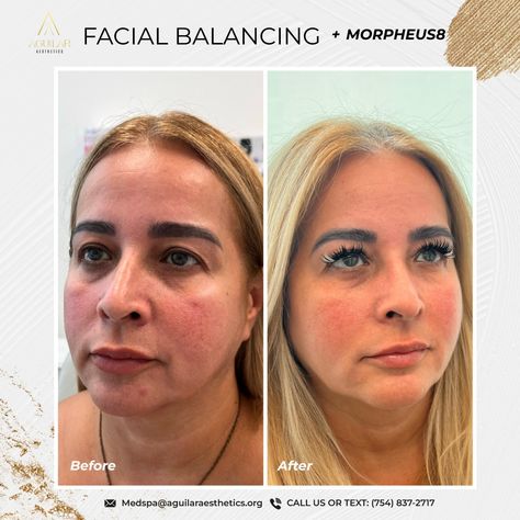 ✨ Facial Balance & Harmonization with Morpheus8 Technology ✨ Achieve rejuvenated skin and a balanced look with our combination of facial harmonization techniques and advanced Morpheus8 technology! Through a personalized approach, we redefine and sculpt facial contours, soften fine lines, improve skin texture, and create a refreshed, natural appearance. 💫 ✨ Aguilar Aesthetics & MedSpa 📲754-837-2717 💠www.aguilaraesthetics.com 🏢 ✨ Aguilar Aesthetics & MedSpa 📍 2820 NE 214th Street, Suite 844... Improve Skin Texture, Med Spa, Skin Texture, Improve Skin, Facial, Technology, Texture, Skin, Quick Saves