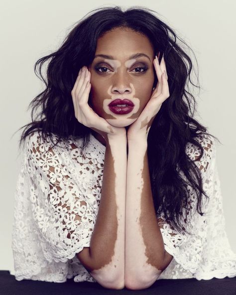 Chantelle Winnie - skin condition called vitiligo - “Diversity is the future of fashion” Chantelle Brown Young, Carmen Dell'orefice, Portrait Women, Make Up Foundation, Winnie Harlow, Face Beauty, Skin Disorders, Natural Beauty Tips, American Horror Story