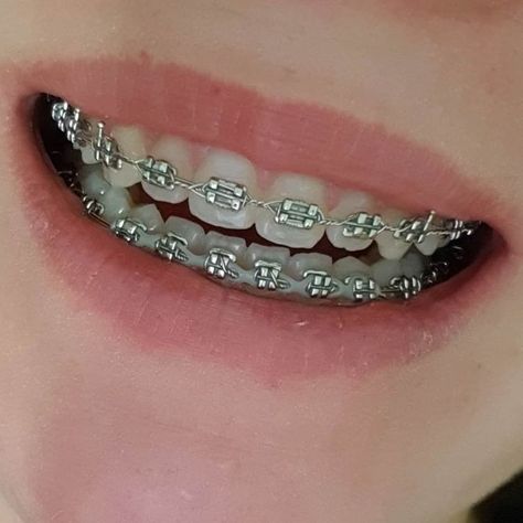 Perfect Teeth Braces, Pink Braces, Smile Tips, Silver Braces, Cute Braces Colors, Pretty Teeth, Braces Tips, Getting Braces, Braces Girls