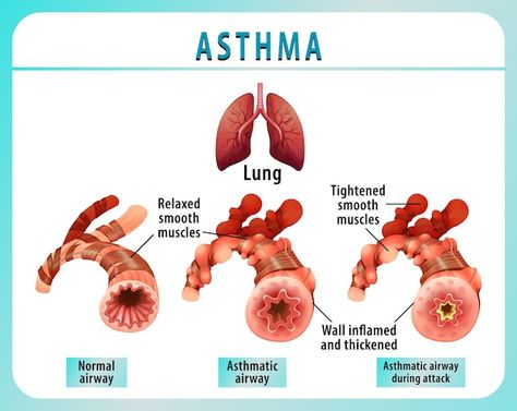 Bronchial asthma diagram with normal air... | Free Vector #Freepik #freevector #physiology #human-anatomy #human-lungs #pulmonary Nicu Nurse Education, Bronchial Asthma, Asthma Relief, Human Lungs, Constant Headaches, Pulmonology, Respiratory Therapy, Lungs Health, Lung Disease