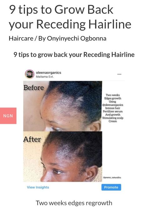 Theses tips will help you revive your hairline and bring your edges back to live.

1. Avoid tight hairstyles: one of the culprits of receding hairline is tight hairstyles. Replace your tight hairstyles to less tight ones or stay away from tight hairstyles entirely. If you’re still making tight hairstyles when trying to grow out your edges, your hairline will prove stubborn to grow out.https
://www.oleenaorganics.com/2022/07/14/grow-back-receding-hairline/ Hairline Growth, Edge Growth, Haircuts For Receding Hairline, Hair Fertilizer, Receding Hair Styles, Hair Growth Foods, Natural Girl, Biotin Hair, Hair Growth Secrets