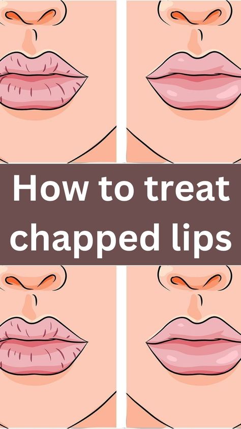 With Winter here, chapped lips are simply inevitable. The colder temperature and harsh winds create the perfect storm, no pun intended, for dried, chapped lips.  Chapped lips can be painful and irritating, creating splits and open cracks on the lip’s surface. And while many chap sticks claim to work, many times, they’re packed with unknown chemicals and ingredients, leaving lips more chapped and dehydrated than before. There are many ways to treat weathered lips with simple products found Chap Lips Remedy, Severely Chapped Lips Remedy, Chap Sticks, Chapped Lips Remedy, Abdominal Stretches, Beauty Hacks That Actually Work, The Perfect Storm, Beauty Hacks Lips, Skin Bumps