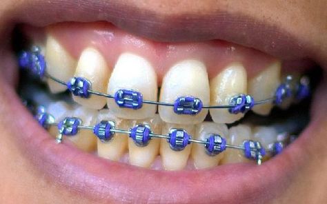 I just got result 'Purple!!' on quiz 'What colour train track braces should I get?'. What will you get? Dark Blue Braces, Purple Braces, Blue Braces, Diy Braces, Fake Braces, Braces Smile, Cute Braces Colors, Braces Cost, Types Of Braces