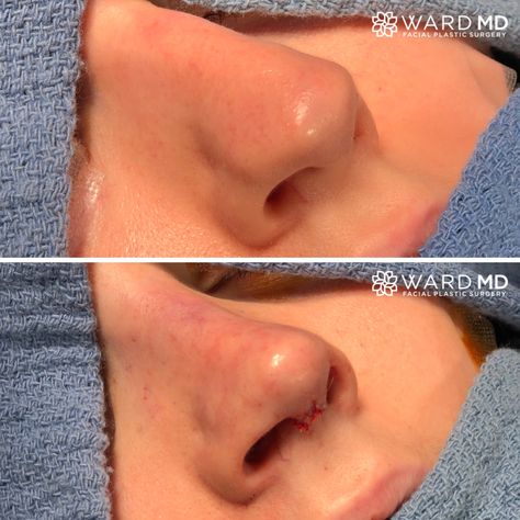 Bulbous Tip Rhinoplasty Before After, Bulbous Nose Before And After, Nose Job Tip Reduction, Tip Rhinoplasty Before After, Rhinoplasty Bulbous Tip, High Radix Nose, Nose Rhinoplasty Before After, Bulbous Nose Job, Upneeq Before And After