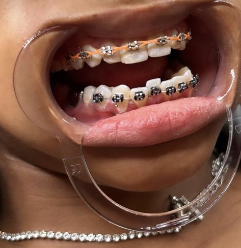 Power Chains, Brace Ideas, Power Chain Braces, Dental Braces Colors, Braces Colours, Braces Aesthetic, Braces Journey, Braces Ideas, Braces Rubber Bands