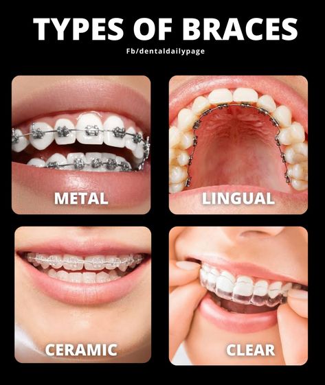 How To Put Braces On Teeth, Type Of Smiles, Star Braces, Color Of Braces, Braces Types, Perfect Teeth Braces, Different Types Of Teeth, Types Of Smiles, Different Types Of Braces