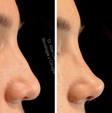 Ski Slope Nose Job, Tinkerbell Tip Lift Nose, Perfect Nose Front View, Nose Job Inspiration, Ethnic Nose Job, Nose Surgery Rhinoplasty, Rhinoplasty Nose Jobs, Rhinoplasty Before And After, Job Inspiration