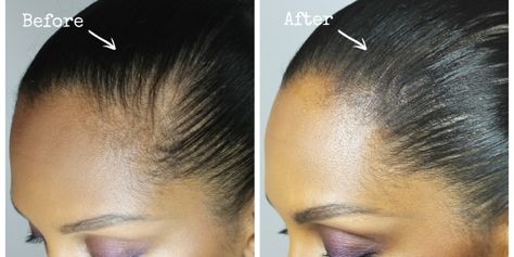 How to hide a bald spot | Melting Pot Beauty Bald Spots Women, Grow Thicker Hair, Bald Patches, How To Grow Your Hair Faster, Bald Spot, Bald Hair, New Hair Growth, Grow Long Hair, Grow Hair Faster