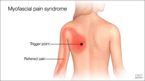 Myofascial Pain Syndrome, Neck And Shoulder Exercises, Referred Pain, Chronic Pain Management, Nerve Health, Chronic Pain Relief, Q And A, Shoulder Pain Relief, Myofascial Release