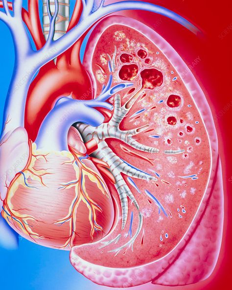 Pulmonary tuberculosis. Illustration of a human lung diseased with pulmonary tuberculosis. At centre right is the affected lung seen sectioned through; at left is the heart with its associated blood vessels. Human Lungs, Wellness Challenge, Challenge Accepted, Frames For Canvas Paintings, Lungs, Affordable Wall Art, Blood Vessels, Cool Posters, Canvas Paintings