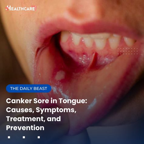 Struggling with canker sores? You’re not alone! These painful mouth ulcers can disrupt your daily life, but knowledge is power! Take charge: Learn the causes, symptoms, and prevention strategies in our latest article. Don’t let discomfort hold you back! #CankerSore #OralHealth #HealthyLiving #HealthcareTips #PainRelief #HealthAwareness #MouthUlcers #TongueCare #WellnessJourney #SelfCare #HealthyMouth #PreventiveCare #Nutrition #StressManagement #HealthyHabits #HealthEducation #DailyHealth #... Canker Sore, Take Charge, Sore Throat, Knowledge Is Power, Health Awareness, Health Education, Oral Health, Hold You, Healthy Habits